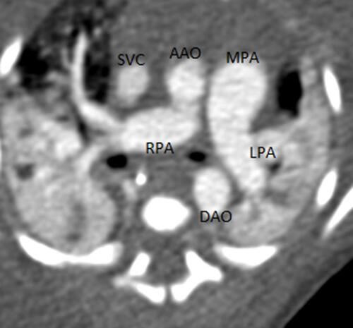 Figure 1 CT angiogram image showing abnormal origin of RPA from ascending aorta (AAO).Abbreviations: SVC, superior vena cava; MPA, main pulmonary artery; DAO, descending aorta; LPA, left pulmonary artery.