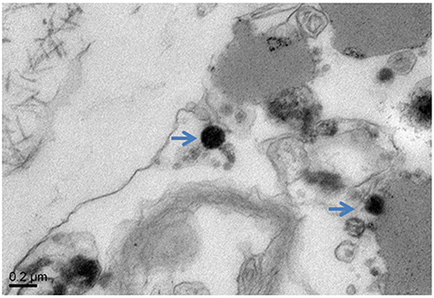 Figure 3 Morphology of L-form NTM (blue arrows) on electron microscopy.