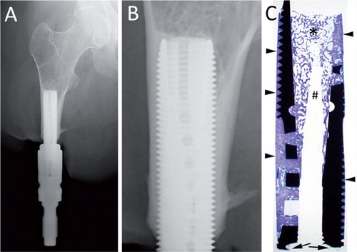 Figure 1. The implant system obtained in 2003. A. Overview image. B. Closer view of the bone-anchored part, showing a large amount of bone surrounding the implant. C. Overview image of the ground section, showing the material fracture at the distal end (arrows), the large amount of mainly compact bone around the implant (arrowheads), and trabecular bone inside the implant (*). There is a central area devoid of tissue due to the retrieval procedure (#).