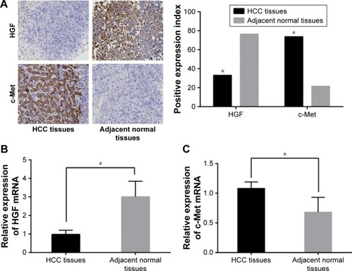 Figure 1 The protein and mRNA expressions of HGF and c-Met expressions in the HCC and adjacent normal tissues (×200). (A) The protein expressions of HGF and c-Met in HCC and adjacent normal tissues; (B) the HGF mRNA expressions in HCC and adjacent normal tissues; (C) the c-Met mRNA expressions in HCC and adjacent normal tissues; *P<0.05 compared with the adjacent normal tissues.