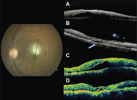 Figure 2 Fundus photography at baseline. Radial scans at baseline by SD-OCT A) and TD-OCT C) shows increased thickness at the lesion site and foveal subretinal fluid. At follow up, residual fluid (arrowhead) both by SD-OCT B) and TD-OCT D). Partial detachment of the posterior hyaloid and adhesion to the fovea only seen by SD-OCT (asterisk).