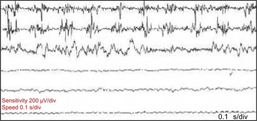 Figure 2 Postural tremor in a patient with OT.