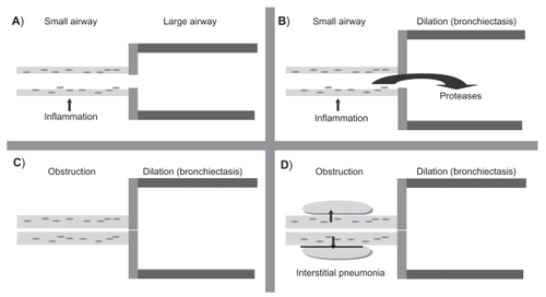 Figure 2 Pathologic changes in follicular bronchiectasis as described by Whitwell. A) The first process involves infection of the small airways. B) This leads to the release of inflammatory mediators such as proteases which damage the large airways resulting in bronchial dilation and bronchiectasis. C) Infection drives progressive inflammation in the small airways which become thicker from a combination of cell-mediated inflammatory infiltrate and lymphoid follicles resulting in obstruction. D) The final process involves the spread of inflammation beyond the airways resulting in interstitial pneumonia.