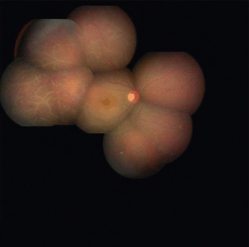 FIGURE 1  Fundus photograph of right eye pre-therapy showing retinal vessels with perivascular sheathing with scattered areas of retinal hemorrhages along the macular edema before treatment.