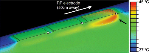 Figure 8. Simultaneous ground pad activation: temperature at skin and pad surfaces and in tissue (ground pads = black outline) after 12 min of RF ablation at 0.3 A current. Tissue is cut through center of thigh, and pads. Black arrow shows hottest area (leading edge). White dots mark locations where temperatures are shown in Figure 10.