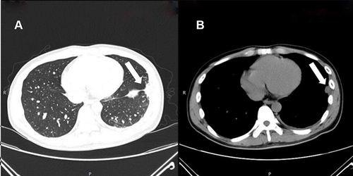 Figure 1 Chest computed tomography on the first visit to our hospital: pneumonia can be seen in the left lower lobe on lung window (A) and mediastinal window (B) (arrows).