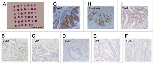 Figure 1. Immunohistochemistry staining results. (A) The construction of tissue array (5x), scale bar: 100 μm; (B-F) The staining of immune cells markers: CD68, CD4, CD8, CD3 and CD20 (20x); (G) The staining of cancer stemness markers: membranous CD44v6 (20x), scale bar: 100 μm; (H-I) The staining of epithelial-mesenchymal transition markers: membranous E-cadherin and nuclear Snail (20x), scale bar: 100 μm.