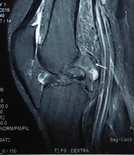 Figure 3 Knee joint MRI of T2 weighted sagittal view show a nodular tissue formation on the posterior part of tibiofemoral joint (white arrow).