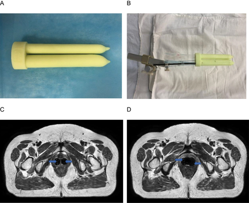 Figure 2 (A) Photographs of the three-dimensional (3D)-printed applicators. (B) Catheters with copper sulfate were placed in two 3D-printed applicators. (C and D) T2-weighted magnetic resonance images were obtained after the catheters with copper sulfate were placed in two 3D-printed applicators. The catheters with copper sulfate are represented by blue arrows.