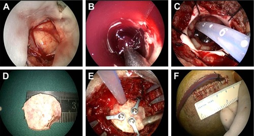 Figure 2 Surgical approach for a basal ganglia hemorrhage.