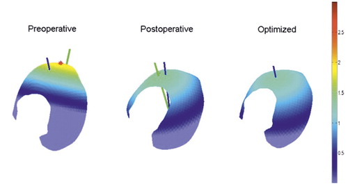 Figure 2. Mechanical results in which the postoperative outcome matched closely with the optimum contact pressure profile (patient 11). The blue line shown passing through the joint contact surface represents the force applied through the hip, while the green line represents the displacement direction of the femoral head. In the optimized case, the lines are collinear. Scale units are MPa.