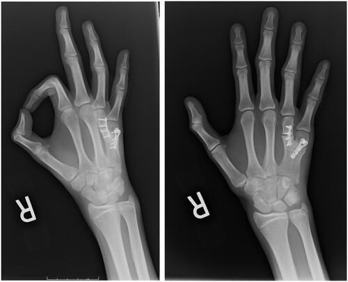 Figure 4. Postoperative radiographs of the patient’s right hand taken at 4 months after surgery.