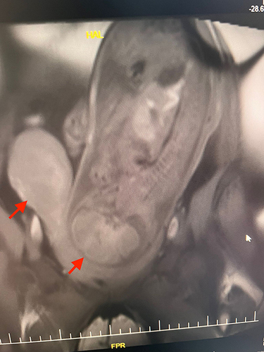Figure 2 Magnetic resonance image showing two adjacent noncommunicating uteri (arrows), one of which is empty and the other is bearing a fetus.