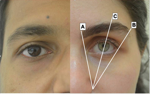 Figure 1 Ideal eyebrow shapes in men and women.