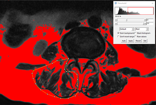 Figure 3 Paravertebral muscle fat measurements by manually tracing the contours of the erector spinae and multifidus muscles in ImageJ software.