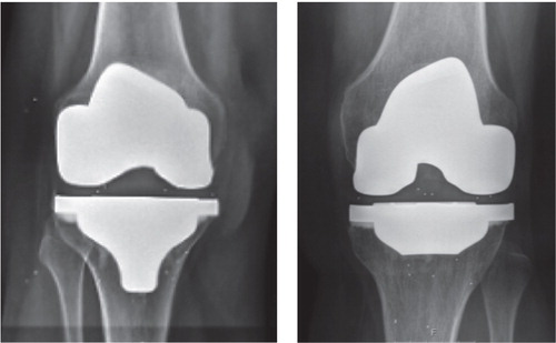 Figure 1. Standard stem (left) and short stem (right).