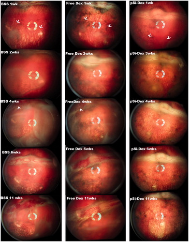 Figure 3. pSiO2-COO-DEX treatment vs. controls. The images of the left column are from a control eye (BSS injection); the images in the middle column are from one of the free Dex injected eyes; and the images of the right column are from an eye treated by intravitreal pSiO2-COO-DEX (pSi-Dex). All eyes were relatively quiet during the first week after subretinal VEGF/Matrigel injection and the clear vitreous allows identification of the two subretinal blebs (arrows) on the color fundus images. After pharmacological intervention, severe vitritis emerged in the eyes injected with BSS or free Dex. Retinal neovascularization on the medullary ray (arrowheads) was spotted during week 4 and persisted until the end of the study. In contrast, vitritis was mild and no neovascularization was noted on the medullary ray in the eyes injected with pSiO2-COO-DEX (far right column).