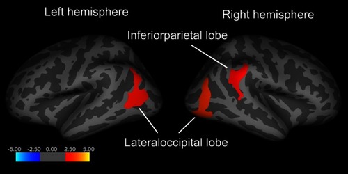 Figure 1 Comparison of the cortical thicknesses of patients with major depressive disorder (MDD) and healthy controls (HCs). Red and orange clusters representing significantly thinner cortical regions (bilateral lateral occipital and right inferior parietal lobes) in patients with MDD (FWE corrected P<0.05).
