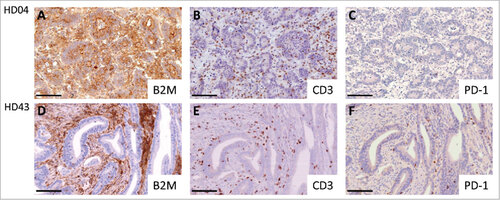 Figure 1. Representative immunohistochemical stainings with the B2M-specific mAb L368 (panel A+D), the CD3-specific mAb PS1 (panel B+E) and the PDCD1 (PD-1)-specific mAb NAT105 (panel C+F). A Homogenous B2M expression in a B2M-wild type tumor (HD04). B Representative CD3-positive T cell expression in a B2M-wild type tumor. C Low amount of PDCD1 (PD-1)-positive T cells in a B2M-wild type tumor. D Absent B2M expression on the tumor cell surface in a B2M-mutant tumor (HD43). E Representative image of CD3-positive T cell infiltration in a B2M-mutant tumor. F B2M-mutant tumor, highly infiltrated with PDCD1 (PD-1)-positive T cells. Scale bars, 100 μm.