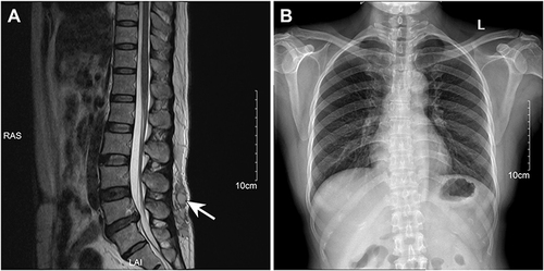 Figure 1 Imaging examination. (A) Magnetic resonance imaging (MRI) of vertebra lumbalis showed a 26 mm × 73 mm subcutaneous abscess with low signal intensity on T1WI and high signal intensity on T2WI (arrows). (B) The chest radiograph showed that the patient’s lungs were normal.