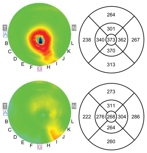 Figure 2 Retinal thickness map of the macula, with ETDRS thickness analysis in micrometers, obtained using OCT, in a patient with stage 4 macular hole. Preoperative (top) and postoperative (bottom).