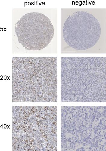 Figure 1 Representative RNA in situ hybridization images of CD24 mRNA negative expression and positive expression.