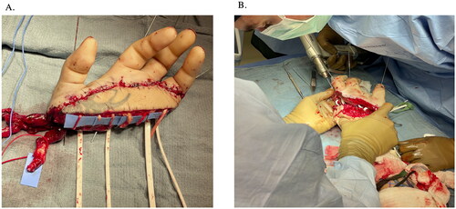 Figure 4. (A) 0.045-inch K-wires placed down each of the amputated digits in a retrograde fashion. (B) Osteosynthesis with K-wires was then performed, achieving bony rigidity and stability.