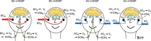 Figure 6 Using BC stimuli, the vibration reaches the right (VR) and the left (VL) vestibular organ by approximately the same intensity at frequencies around 250 Hz.