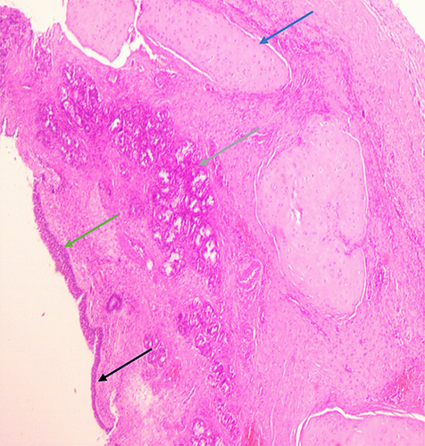 Figure 5 Histopathological examination revealed a cystic lesion lined partially by stratified squamous epithelium (green arrow) and partially by pseudostratified columnar epithelium (black arrow), the cyst wall is composed of fibrous tissue, mucinous glands (grey arrow), cartilaginous tissue (blue arrow), and mixed inflammatory cells (H&E, 4x).