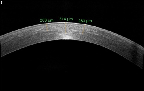 Figure 2 AS-OCT of keratoconus eye 6 months after epi-off corneal cross-linking radiating with UV-A at 3 mW/cm2.