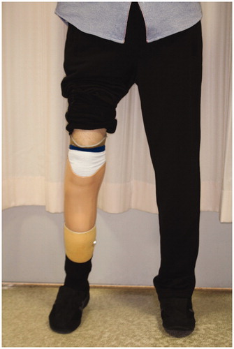 Figure 6. Patient’s condition while standing. The patient was able to walk by himself using a prosthesis for his right foot. He does not require a prosthesis for the left foot.