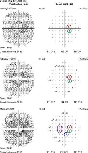 Figure 3 Three consecutive 10–2 visual fields with a red target in a patient taking hydroxychloroquine at toxic doses who developed retinopathy.