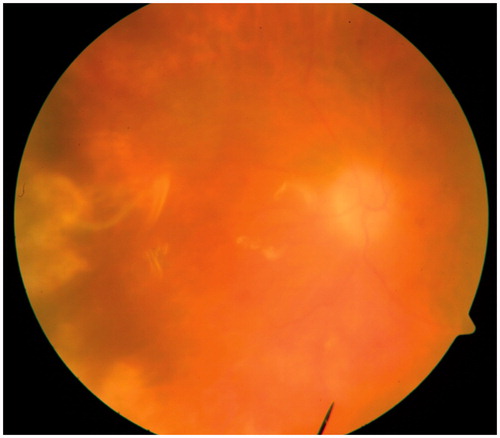 Figure 3. Fundus photograph (case 1) 3 days after surgery (pars plana vitrectomy + partial retinectomy + endolaser photocoagulation + silicon oil tamponade) showing attached retina in a silicon-oil filled eye.