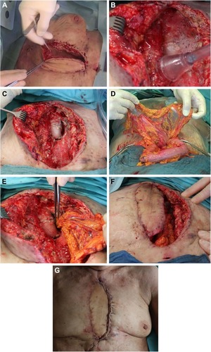 Figure 1 Typical stages of a omentoplasty for coverage of artificial material in case of DSWI.