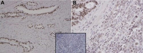 Figure 3 EME1 immunohistochemistry in gastroesophageal junction adenocarcinoma. (A) Well-differentiated gastroesophageal junction adenocarcinoma shows uniform strong nuclear staining pattern with EME1 (250×). (B) EME1 staining intensity was noticeably less in the less differentiated areas (500×). Note the nuclear immunoreactivity for EME1 in a control of benign endometrial stroma (inset).