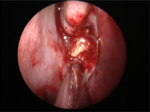 Figure 5 Intraoperative finding of sphenoid fungal ball.