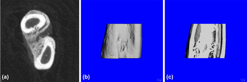 Figure 11. Postoperative 6-week Bone Union of Blank Group. a. cross section showed good bone union with a great quantity of calluses formed; b. three-dimensional reconstruction showed no obvious fracture line; and c. coronal section showed plenty of bony calluses and obstructed marrow cavity.