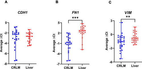 Figure 1 Expression of FN1 and VIM is decreased in colorectal liver metastasis when compared with non-tumor liver tissue, while expression of CDH1 is similar. Expression of CDH1 (A), FN1 (B) and VIM (C) in CRLM and surrounding non-tumor liver tissue measured by qRT-PCR. Data are presented as average ΔCt values (median with range). **P <0.01; ***P <0.001.