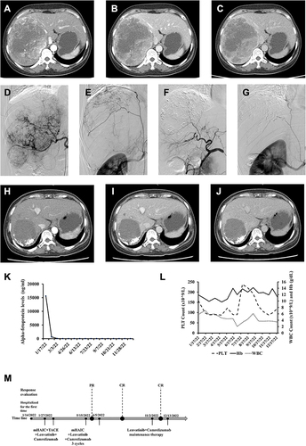 Figure 1 Changes in case 1 in imaging and laboratory tests during clinical treatment. Enhanced CT images before introducing mHAIC. A 14×11 cm mass is shown in the right liver in the arterial phase (A), portal phase (B) and delayed phase (C). Enhanced CT images after introducing mHAIC. (D) DSA via an implantable port-catheter system, before mHAIC, demonstrated large tumour stains of HCC. (E) The subphrenic artery develops from the beginning of the renal artery and supplies blood to the tumour area. (F and G) After 4 cycles of mHAIC, DSA clipping of the hepatic and subphrenic arteries showed no tumour staining. A 7×6 cm mass is shown in the right liver in the arterial phase (H), portal phase (I) and delayed phase (J). (K) AFP level changes during postoperative mHAIC. (L) Changes in WBC, PLT, and HGB of patients during treatment. (M) Timeline of the treatment process.