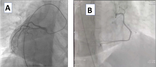 Figure 4 Coronary angiogram of the left (A) and right (B) coronary arteries.