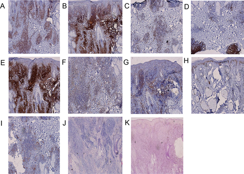 Figure 3 (A–K) CD3 (+), CD4 (+++), CD8 (+), CD20 (+), CD1a (+), CD43 (+), CD68 (+), Ki-67 10% (+), CD123 (-), acid-fast dyeing (-), PAS (-).