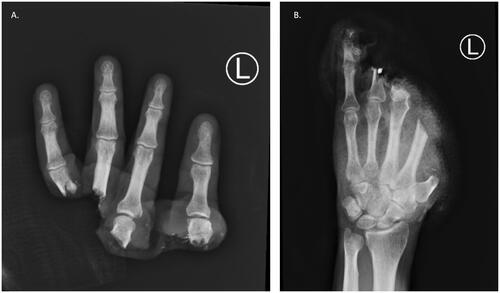 Figure 1. Left-hand and wrist radiography.Complete amputation of left-hand digits one through four with a sustained an open fracture-dislocation of the fifth finger on that side. First and second metacarpal fractures, open proximal phalangeal fractures of the middle and ring finger, and open fracture dislocation through the DIP joint of the small finger were found. There was trans metacarpal thumb and index amputation and a cross-proximal phalanx of middle and ring finger amputation.