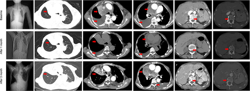 Figure 4 Tumor response to savolitinib treatment. The CT scan shows that some lesions (red arrow) in the baseline and 1 and 3 months after savolitinib. The red arrows indicate locations that correspond to tumor foci.