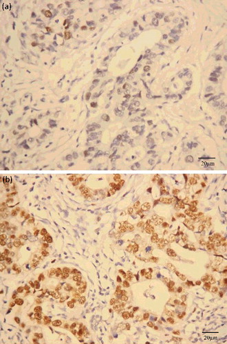 Figure 1. (Color online) 8-OHdG immunostaining in gastric cancer tissues with low label index (a) and high label index (b). Cells with a brown-stained nucleus are regarded as positive.
