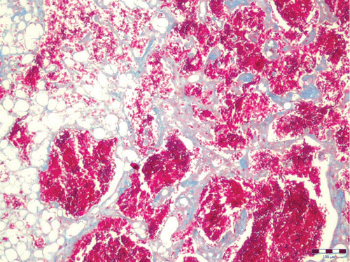 Figure 3. Masson's trichrome stained the smooth muscle portions of the mixed mesenchymal tumour bright red, and the collagen blue. Masson's trichrome. Bar: 100 µm.