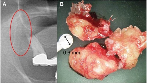 Figure 1 (A) Red oval shows location of fatty-degenerative osteolysis of the jawbone; (B) 1:15 scale, morphology of fatty-degenerative osteolysis.