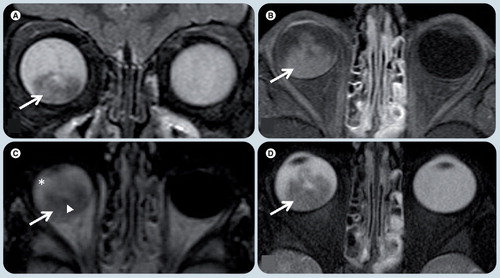 Figure 11. Retinoblastoma.(A) Coronal T2-weighted, (B) axial T1-weighted fat-supressed postgadolinium, (C) axial FLAIR, and (D) axial T2-weighted MRI demonstrate a heterogeneous mass in the posterior and inferior right globe (white arrows). (A & D) The lesion is T2 hypointense with respect to the vitreous. (B) The tumor has marked enhancement after contrast administration. (C) On a FLAIR image the mass has heterogeneous signal intensity and the vitreous shows abnormal signal intensity (white asterisk), likely due to protein exudate. There are small foci of hyposignal in the mass (white arrowhead in (C)) that represent speckle calcifications.