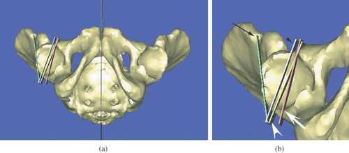 Figure 7. Clinical application of the validated interplane measurement protocol to determine variations in acetabular anteversion in a 3D CT-generated computer model of the pelvis. (a) Low magnification view. (b) High magnification view of right acetabulum demonstrating four anteversion planes as measured at different vertical positions of the acetabulum. The superior aspect of the acetabulum is divided into four vertical levels with the lowest level as the equator. Acetabular version at level 1 (green, long black arrow) shows retroversion of 7.75°; level 2 (white, small black arrowhead), level 3 (yellow, large white arrowhead), and level 4 or the equator (red, large white arrow) all demonstrate anteversion of the acetabulum of 19.47°, 21.52°, and 13.55°, respectively. [Color version available online.]