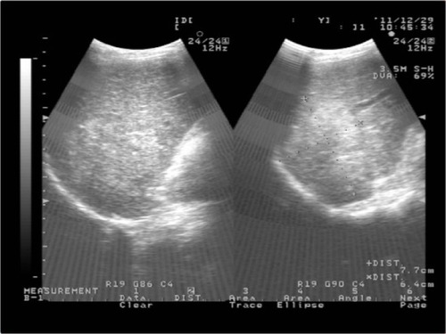 Figure 3 Abdominal B ultrasound showed a large mass in the right lobe of the liver.
