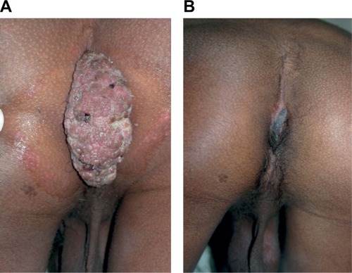 Figure 9 Action of MIP on ugly anogenital warts (A) before treatment and (B) after treatment with MIP.